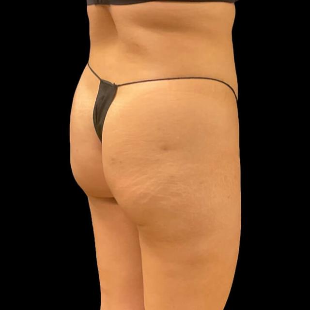Brazilian Butt Lift before at Austin Plastic Surgeon in Austin, TX
