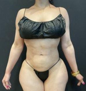 Arm Lift after at Austin Plastic Surgeon in Austin, TX