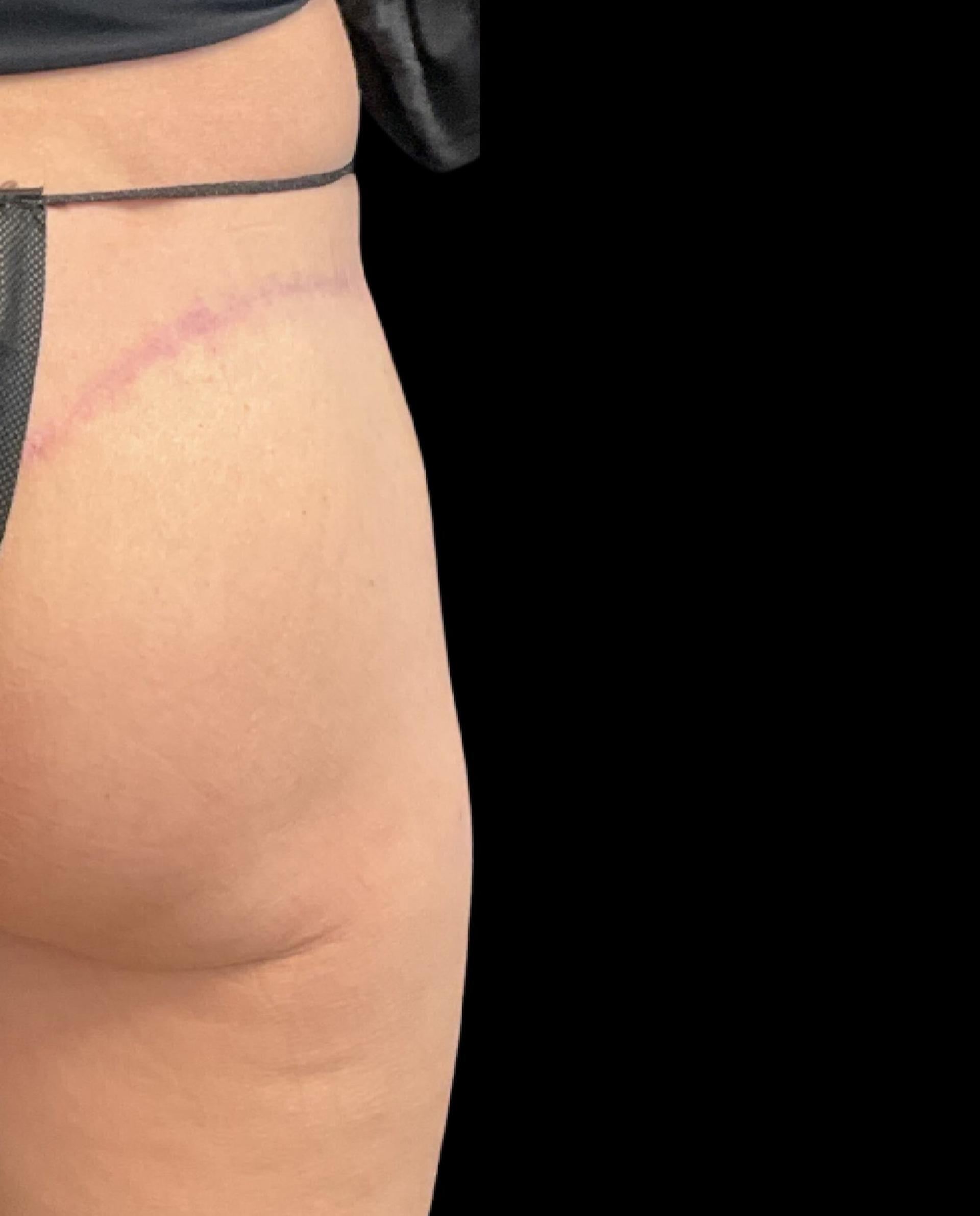 Austin Plastic Surgeon bbl after — Austin, TX