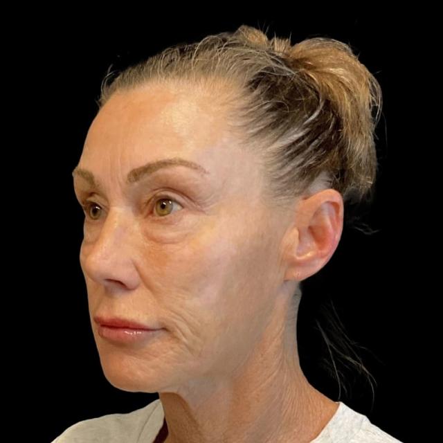 Blepharoplasty before at Austin Plastic Surgeon in Austin, TX