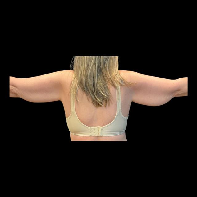 Arm Lift before at Austin Plastic Surgeon in Austin, TX
