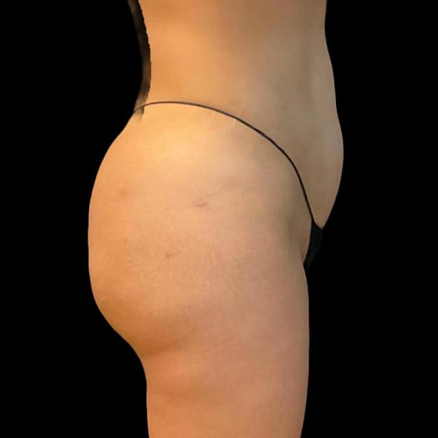 Brazilian Butt Lift after at Austin Plastic Surgeon in Austin, TX