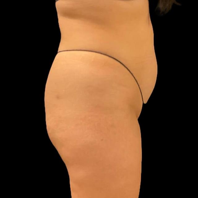 Brazilian Butt Lift before at Austin Plastic Surgeon in Austin, TX