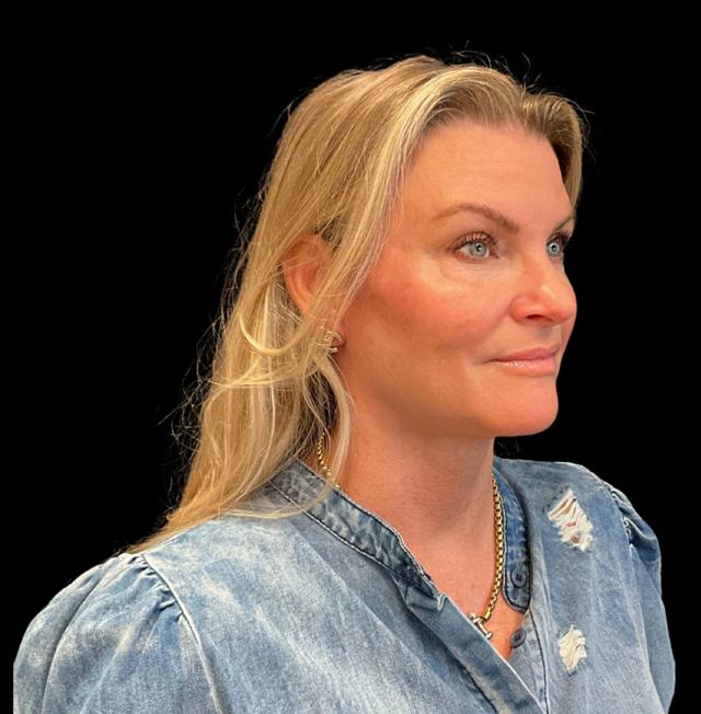 Blepharoplasty after at Austin Plastic Surgeon in Austin, TX