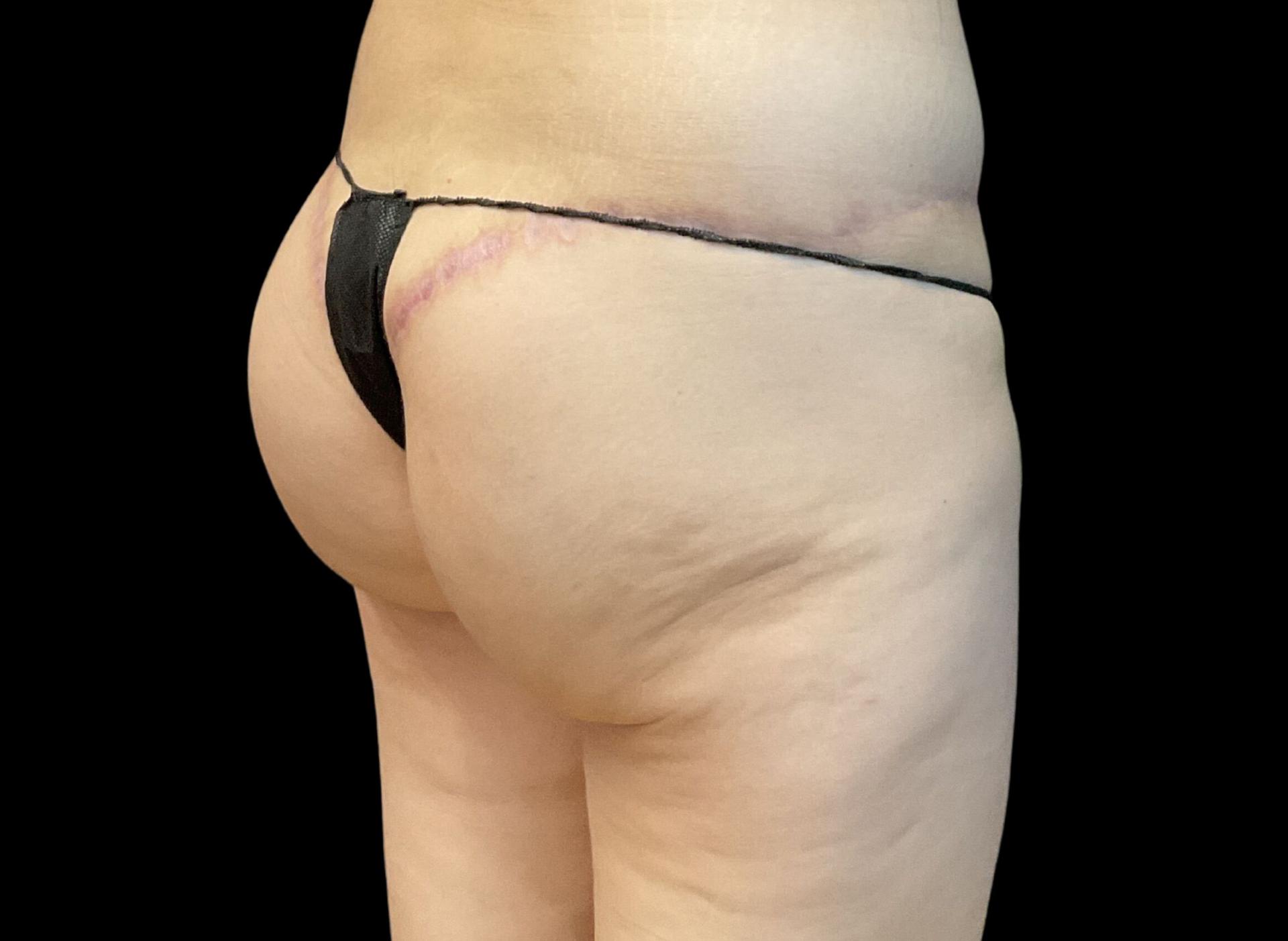 Austin Plastic Surgeon breast augmentation after — Austin, TX