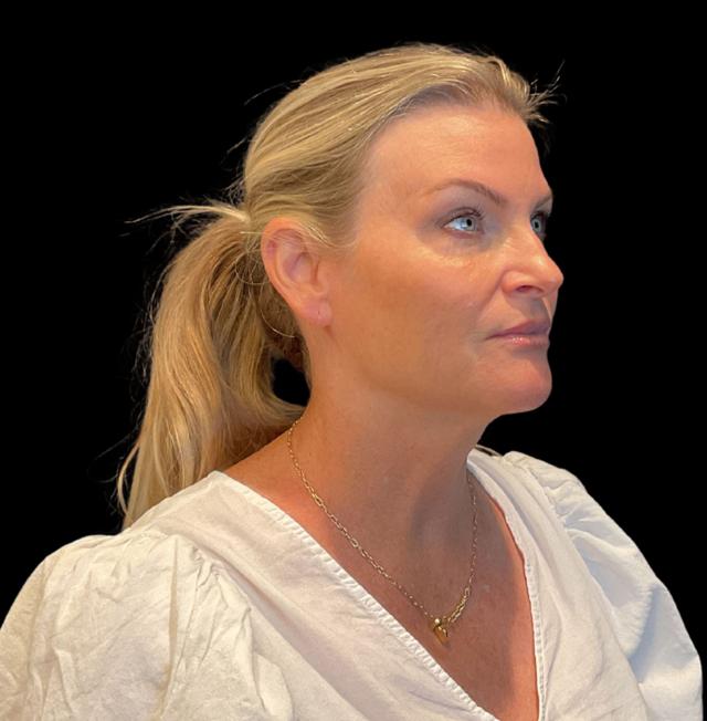 Blepharoplasty before at Austin Plastic Surgeon in Austin, TX