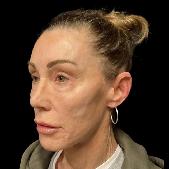 Blepharoplasty after at Austin Plastic Surgeon in Austin, TX
