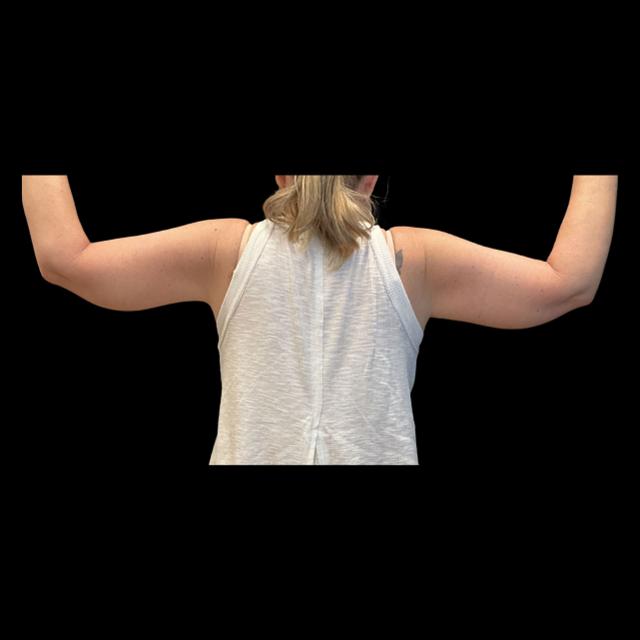 Arm Lift after at Austin Plastic Surgeon in Austin, TX