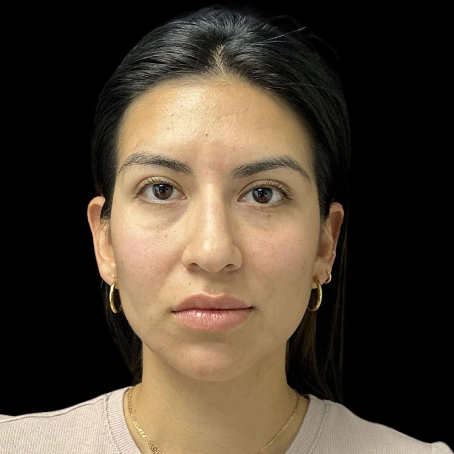 Austin Plastic Surgeon cheek filler after — Austin, TX