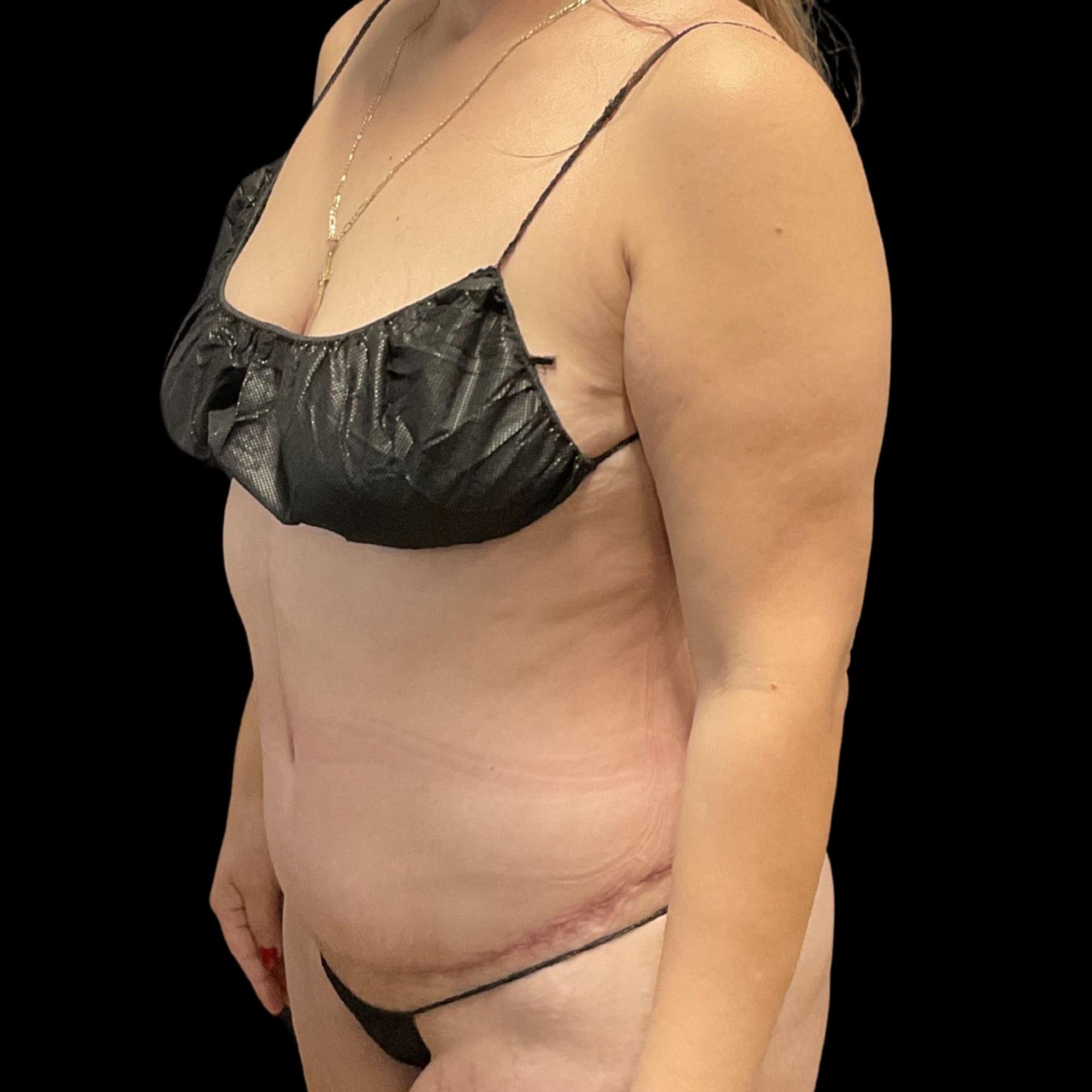 Austin Plastic Surgeon tummy tuck after — Austin, TX