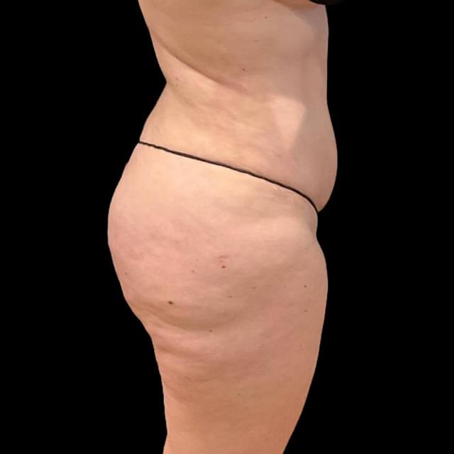 Brazilian Butt Lift after at Austin Plastic Surgeon in Austin, TX