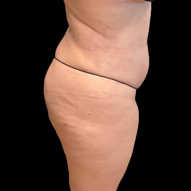 Brazilian Butt Lift before at Austin Plastic Surgeon in Austin, TX