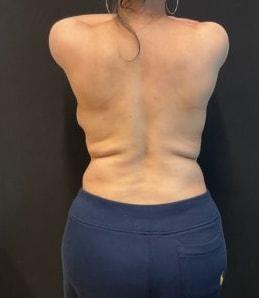 Arm Lift before at Austin Plastic Surgeon in Austin, TX