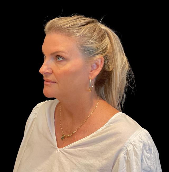 Blepharoplasty before at Austin Plastic Surgeon in Austin, TX