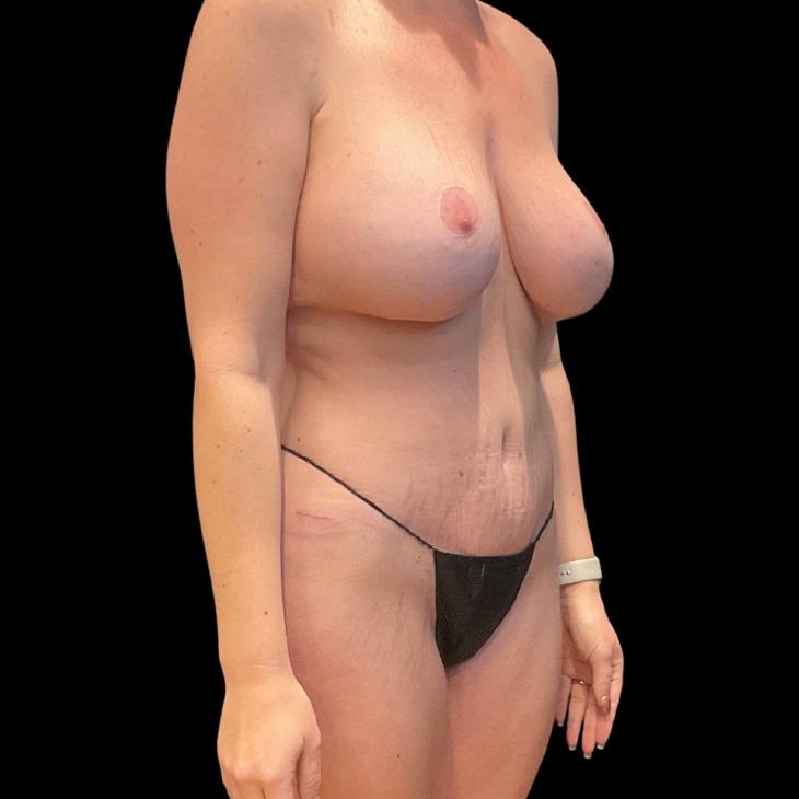 Austin Plastic Surgeon tummy tuck after — Austin, TX