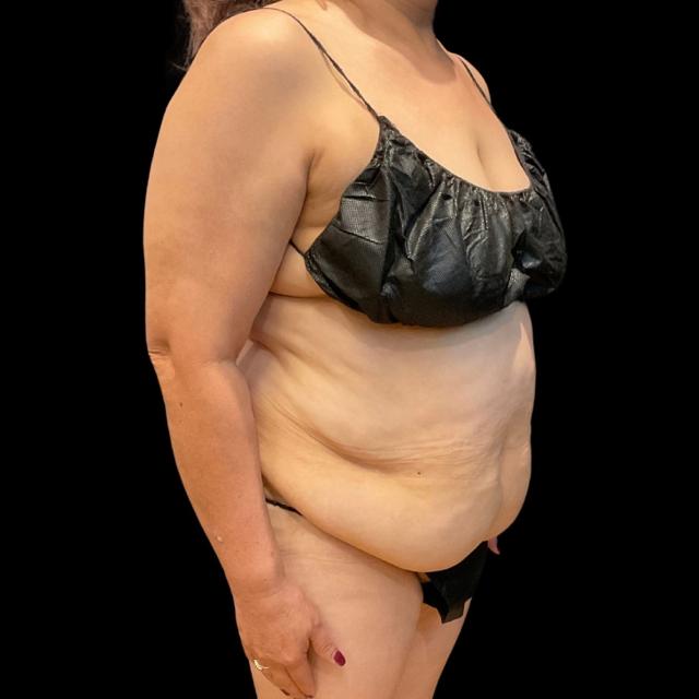 Tummy Tuck before at Austin Plastic Surgeon in Austin, TX