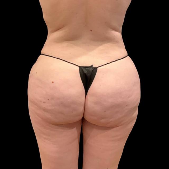 Brazilian Butt Lift after at Austin Plastic Surgeon in Austin, TX