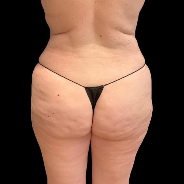 Brazilian Butt Lift before at Austin Plastic Surgeon in Austin, TX