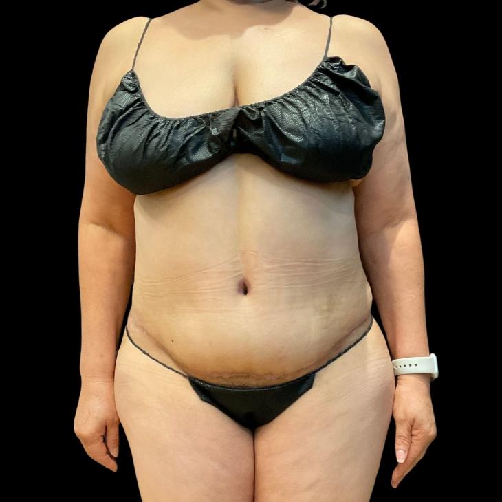 Austin Plastic Surgeon tummy tuck after — Austin, TX
