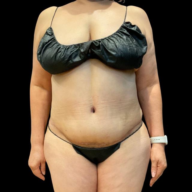 Mini Tummy Tuck after at Austin Plastic Surgeon in Austin, TX