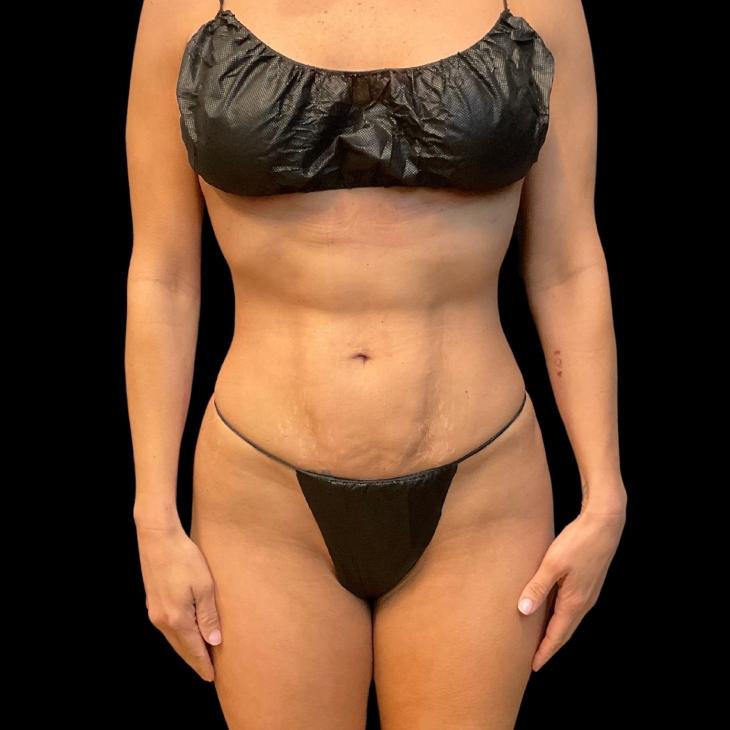 Austin Plastic Surgeon liposuction after — Austin, TX