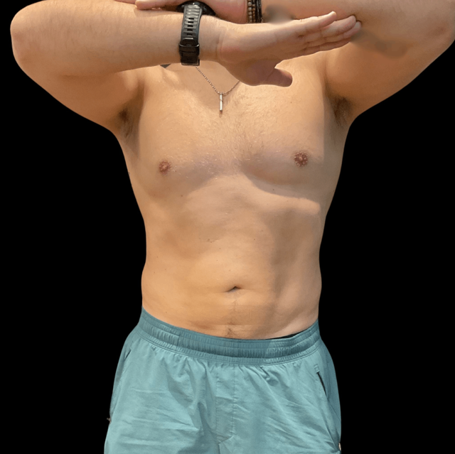 Liposuction after at Austin Plastic Surgeon in Austin, TX