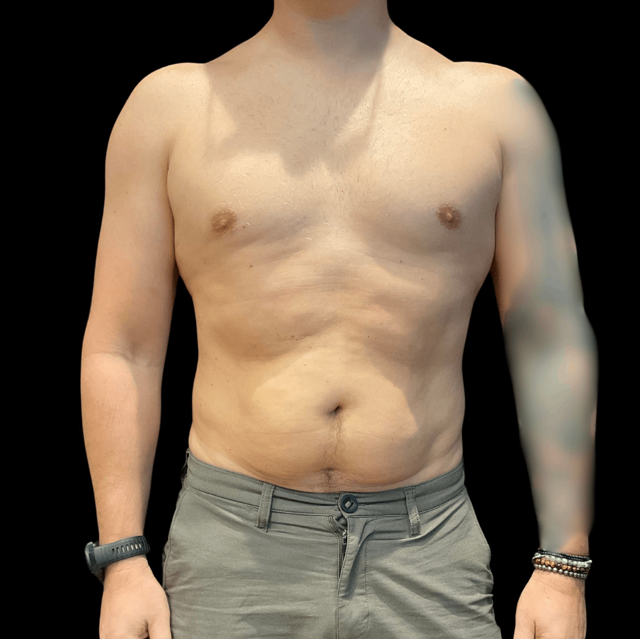 Liposuction before at Austin Plastic Surgeon in Austin, TX