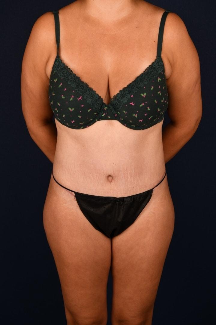 Egrari Plastic Surgery & Non Invasive Center tummy tuck after — Bellevue, WA