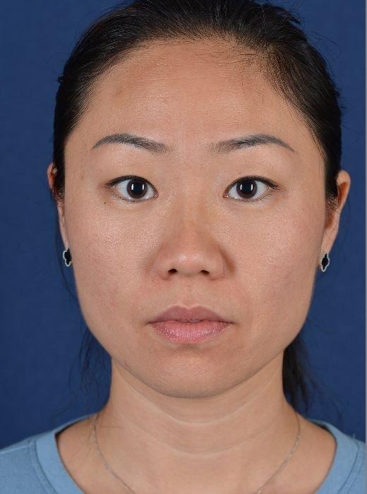 Rhinoplasty before at Egrari Plastic Surgery & Non Invasive Center in Bellevue, WA