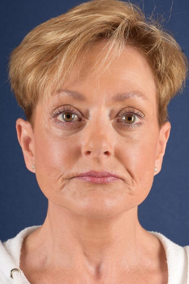 Deep Plane Facelift after at Egrari Plastic Surgery & Non Invasive Center in Bellevue, WA