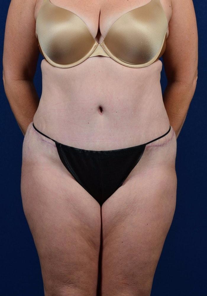 Egrari Plastic Surgery & Non Invasive Center tummy tuck after — Bellevue, WA