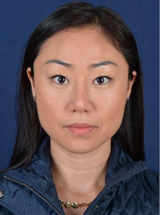 Rhinoplasty after at Egrari Plastic Surgery & Non Invasive Center in Bellevue, WA