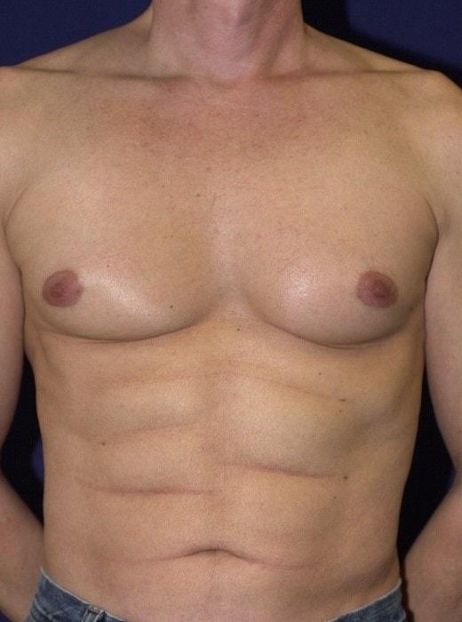 Liposuction after at Egrari Plastic Surgery & Non Invasive Center in Bellevue, WA
