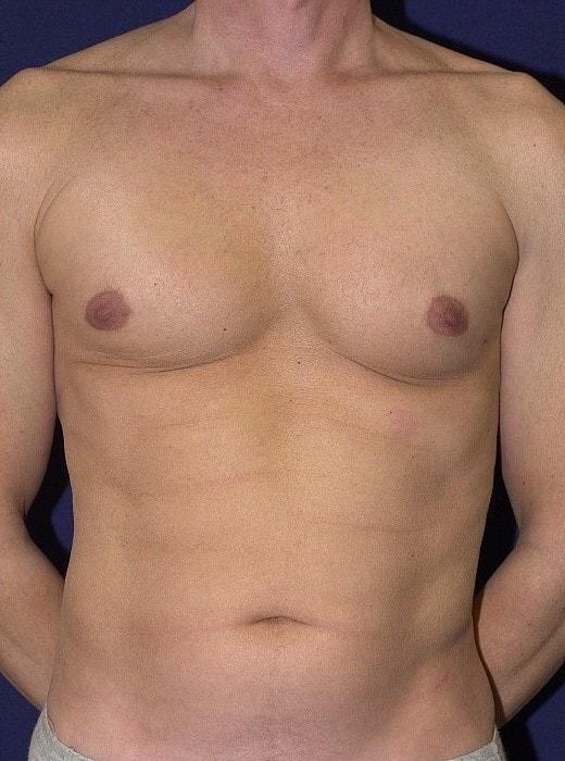 Liposuction before at Egrari Plastic Surgery & Non Invasive Center in Bellevue, WA