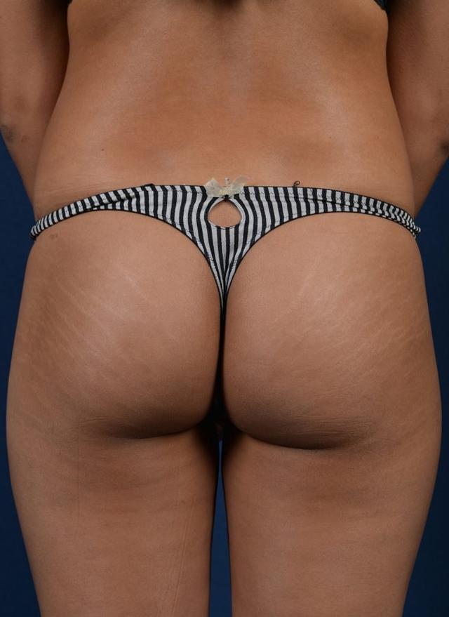 Brazilian Butt Lift before at Egrari Plastic Surgery & Non Invasive Center in Bellevue, WA