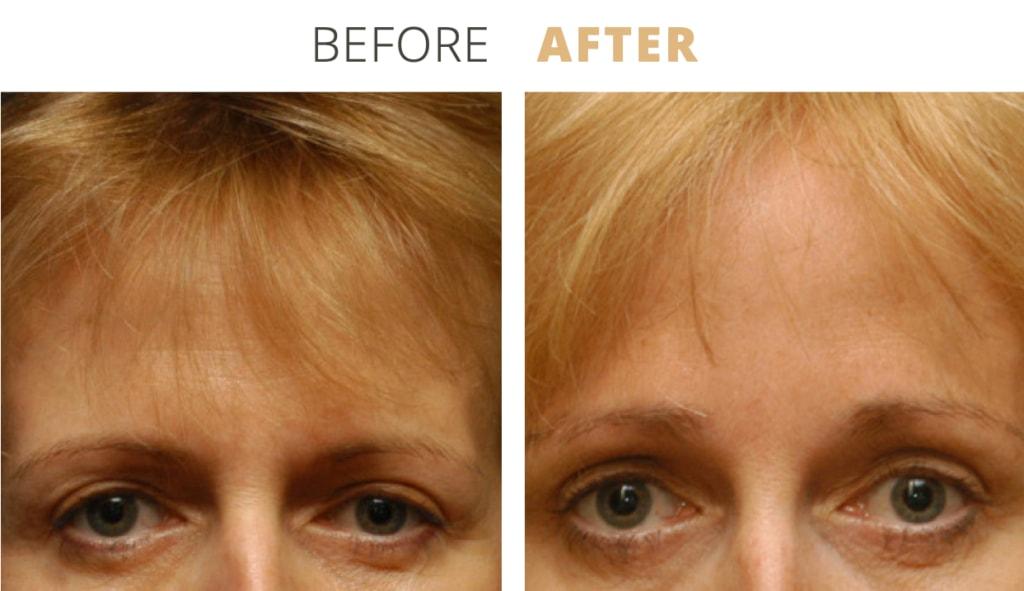Golden Hills Plastic Surgery brow lift result — Walnut Creek, CA