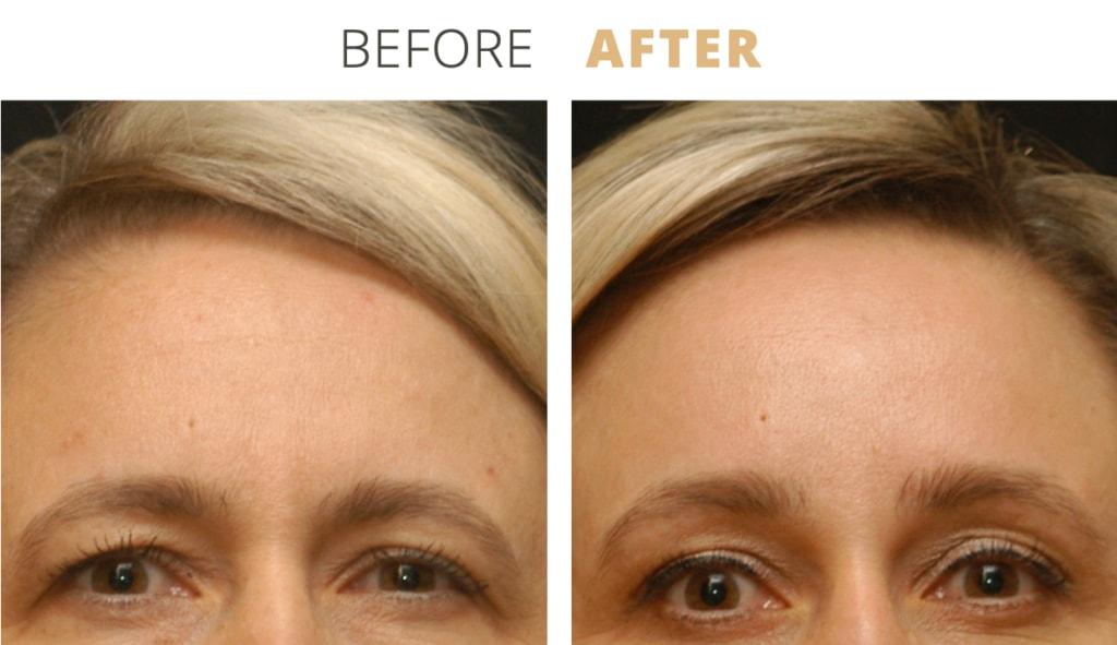 Golden Hills Plastic Surgery brow lift result — Walnut Creek, CA