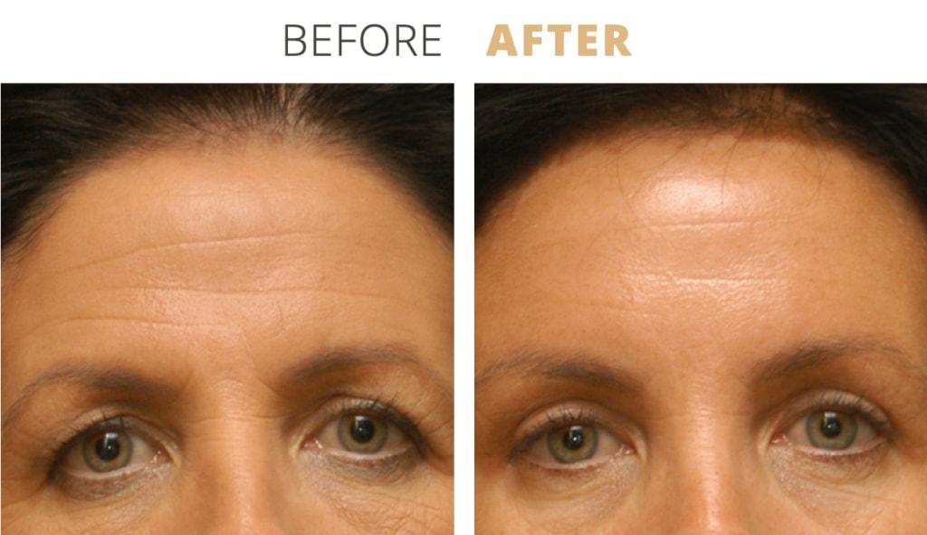 Golden Hills Plastic Surgery brow lift result — Walnut Creek, CA