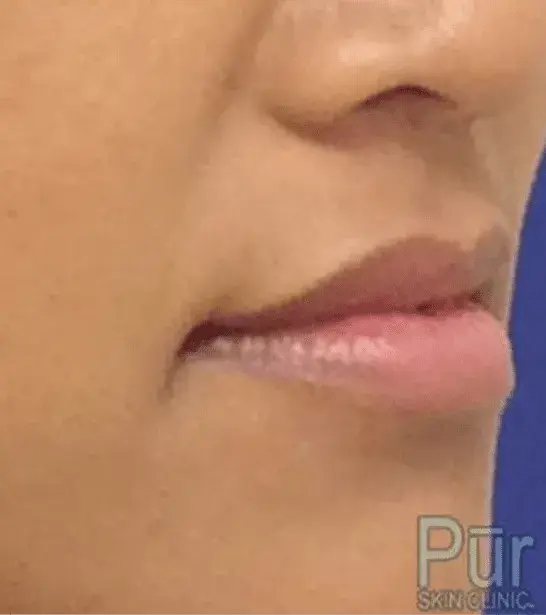 Lip Filler before at Pūr Skin Clinic - Seattle in Seattle, WA