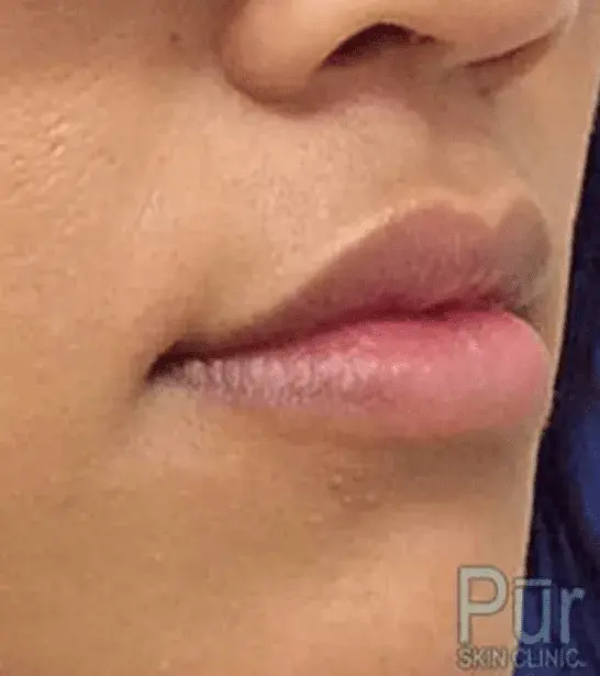 Pūr Skin Clinic - Seattle after — Seattle, WA