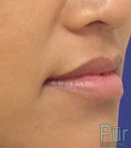 Lip Filler before at Pūr Skin Clinic - Seattle in Seattle, WA