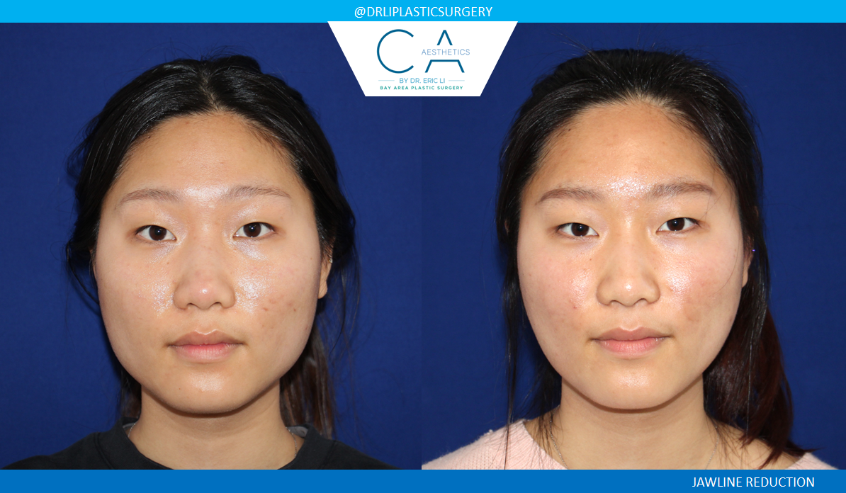 CA Aesthetics: Bay Area Plastic Surgery Eric Li, MD skin tightening result — Campbell, CA