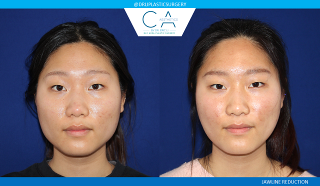 Morpheus8 result at CA Aesthetics: Bay Area Plastic Surgery Eric Li, MD in Campbell, CA