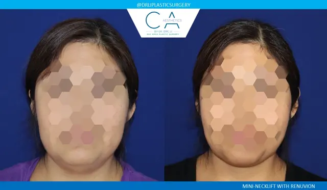 Neck Lift result at CA Aesthetics: Bay Area Plastic Surgery Eric Li, MD in Campbell, CA