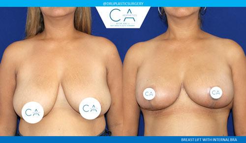 Breast Lift result at CA Aesthetics: Bay Area Plastic Surgery Eric Li, MD in Campbell, CA