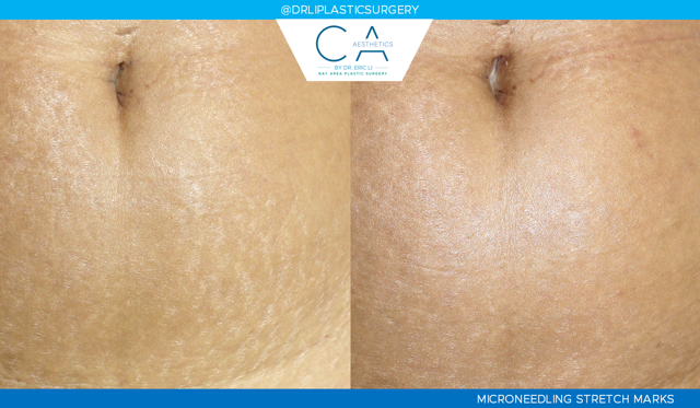 Microneedling result at CA Aesthetics: Bay Area Plastic Surgery Eric Li, MD in Campbell, CA