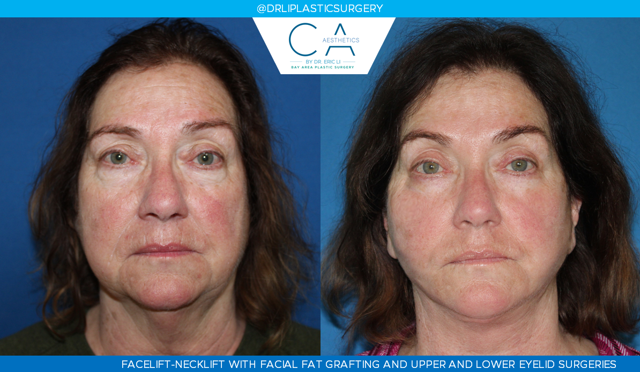 Facelift result at CA Aesthetics: Bay Area Plastic Surgery Eric Li, MD in Campbell, CA