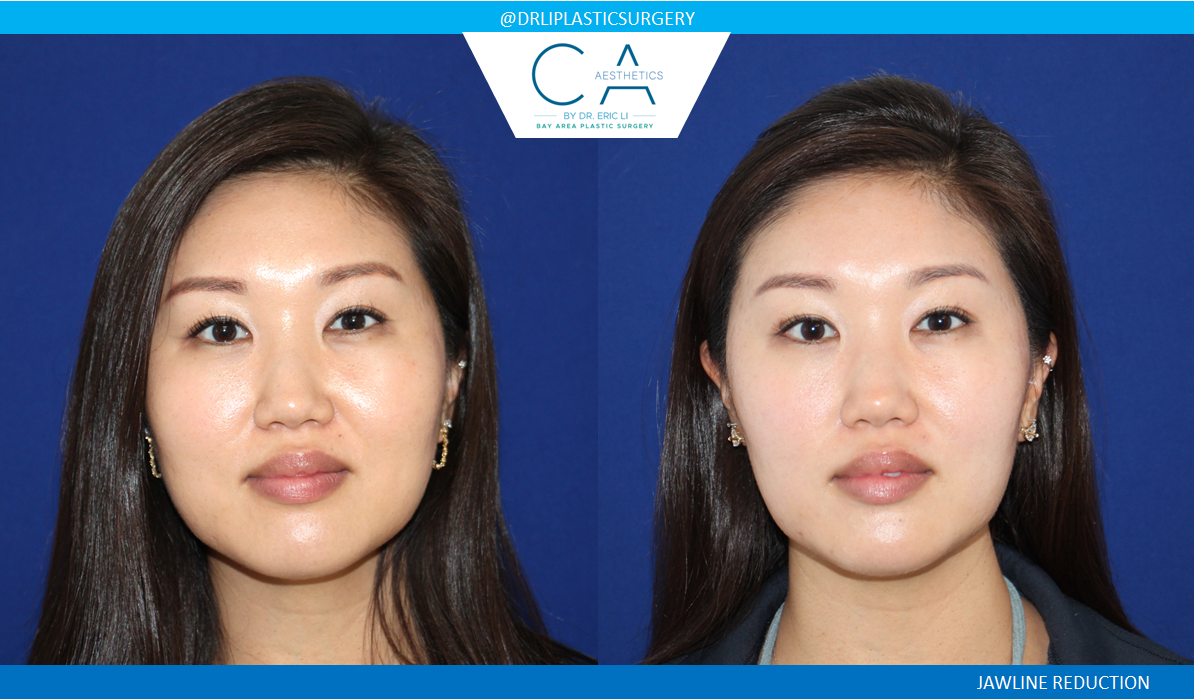 CA Aesthetics: Bay Area Plastic Surgery Eric Li, MD skin tightening result — Campbell, CA
