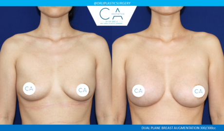 Breast Augmentation result at CA Aesthetics: Bay Area Plastic Surgery Eric Li, MD in Campbell, CA