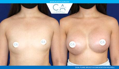 Breast Augmentation result at CA Aesthetics: Bay Area Plastic Surgery Eric Li, MD in Campbell, CA